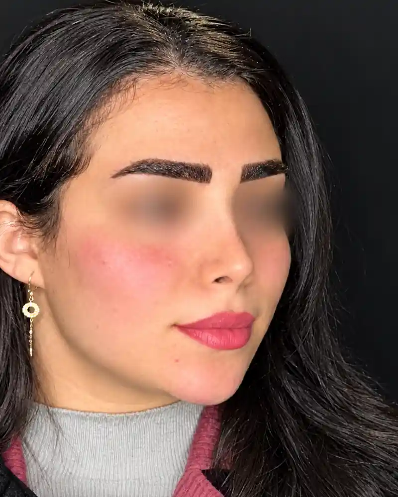 پس از تزریق فیلر گونه و چانه، نمای سه‌رخ؛ چشم‌ها برای حفظ حریم بیمار محو شده‌اند