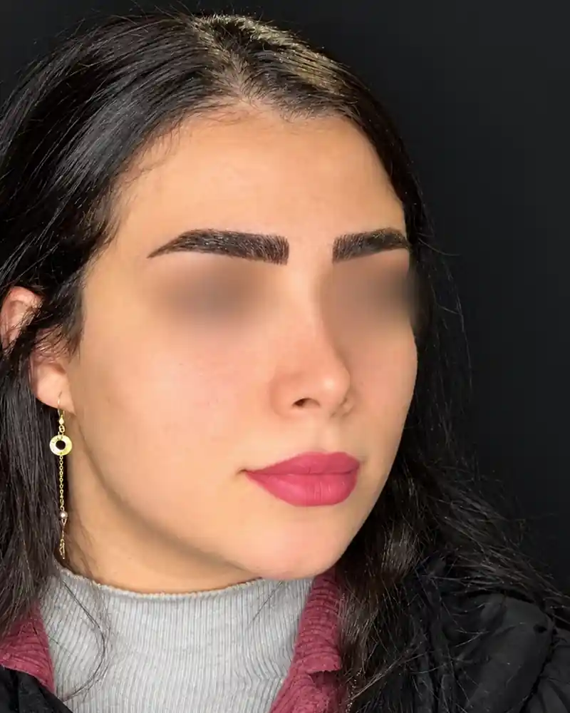 پیش از تزریق فیلر گونه و چانه، نمای سه‌رخ؛ چشم‌ها برای حفظ حریم بیمار محو شده‌اند