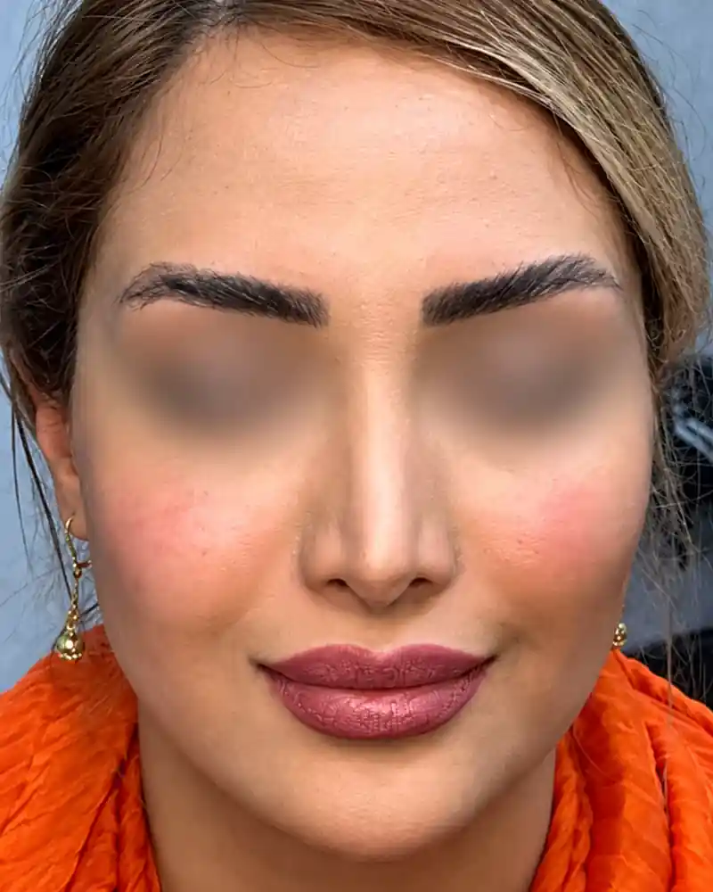 پس از تزریق فیلر لب، نمای روبه‌رو از میانهٔ صورت؛ چشم‌ها برای حفظ حریم بیمار محو شده‌اند
