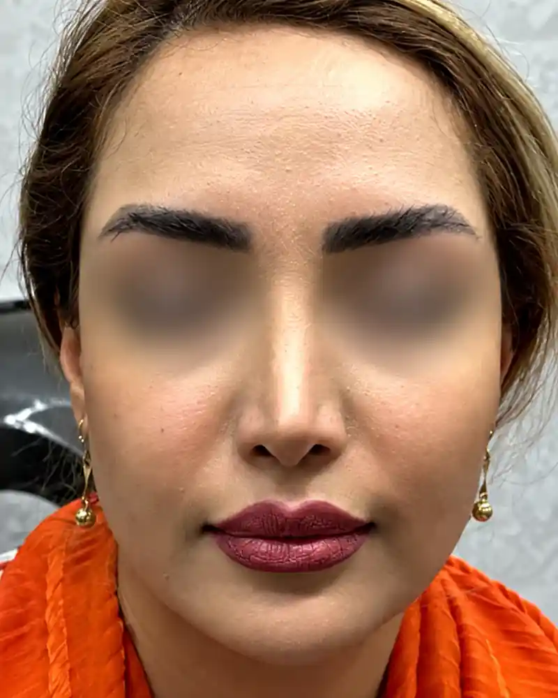 پیش از تزریق فیلر لب، نمای روبه‌رو از میانهٔ صورت؛ چشم‌ها برای حفظ حریم بیمار محو شده‌اند