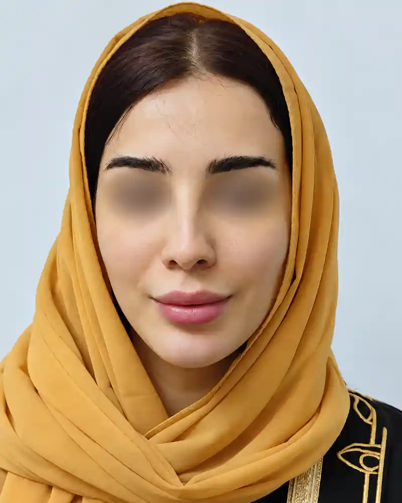 پس از تزریق فیلر لب و چانه، نمای روبه‌رو؛ چشم‌ها برای حفظ حریم بیمار محو شده‌اند