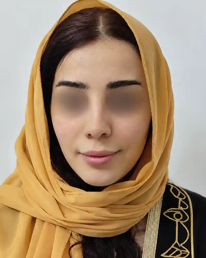 پیش از تزریق فیلر لب و چانه، نمای روبه‌رو؛ چشم‌ها برای حفظ حریم بیمار محو شده‌اند